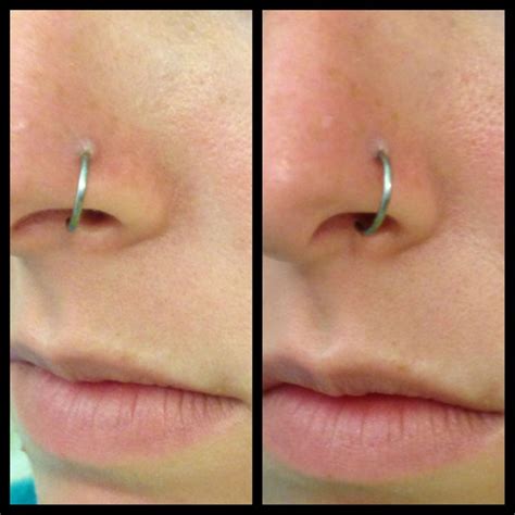 keloid nose ring|nose keloid after piercing.